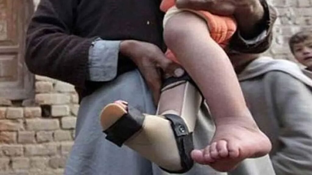 Pakistan sees decline in polio cases
