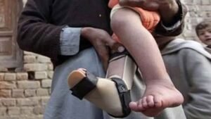 Pakistan sees decline in polio cases