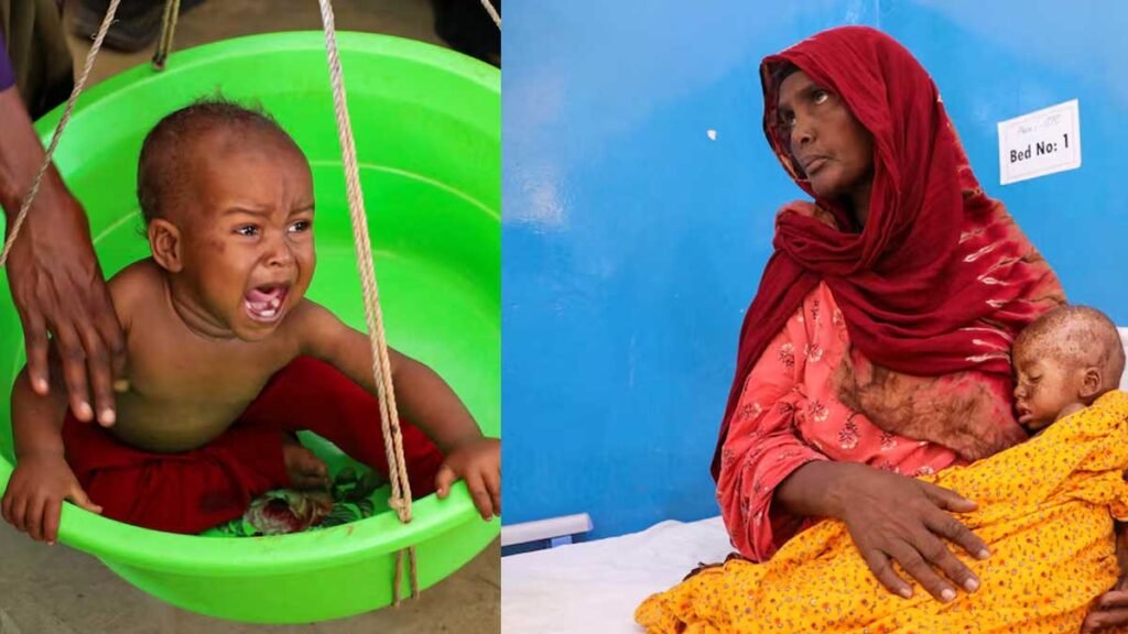 Somalia malnutrition response hit by more than 80% funding drop