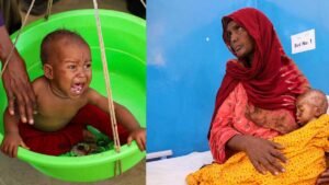 Somalia malnutrition response hit by more than 80% funding drop